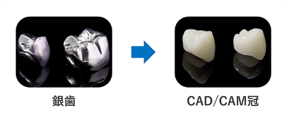 保険適用の白い歯「CAD/CAM冠」