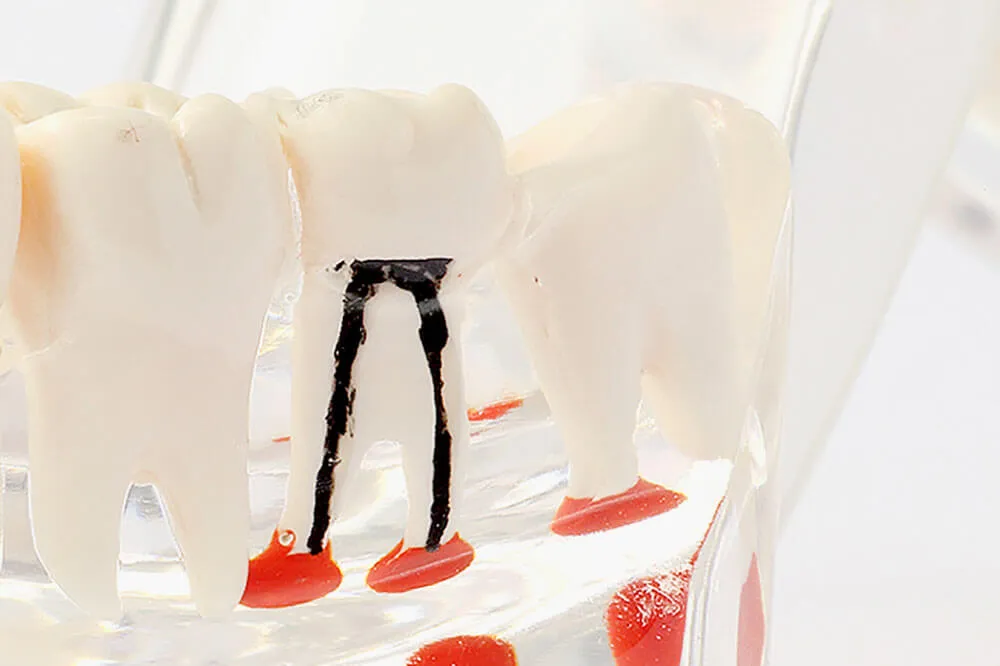 根管治療について